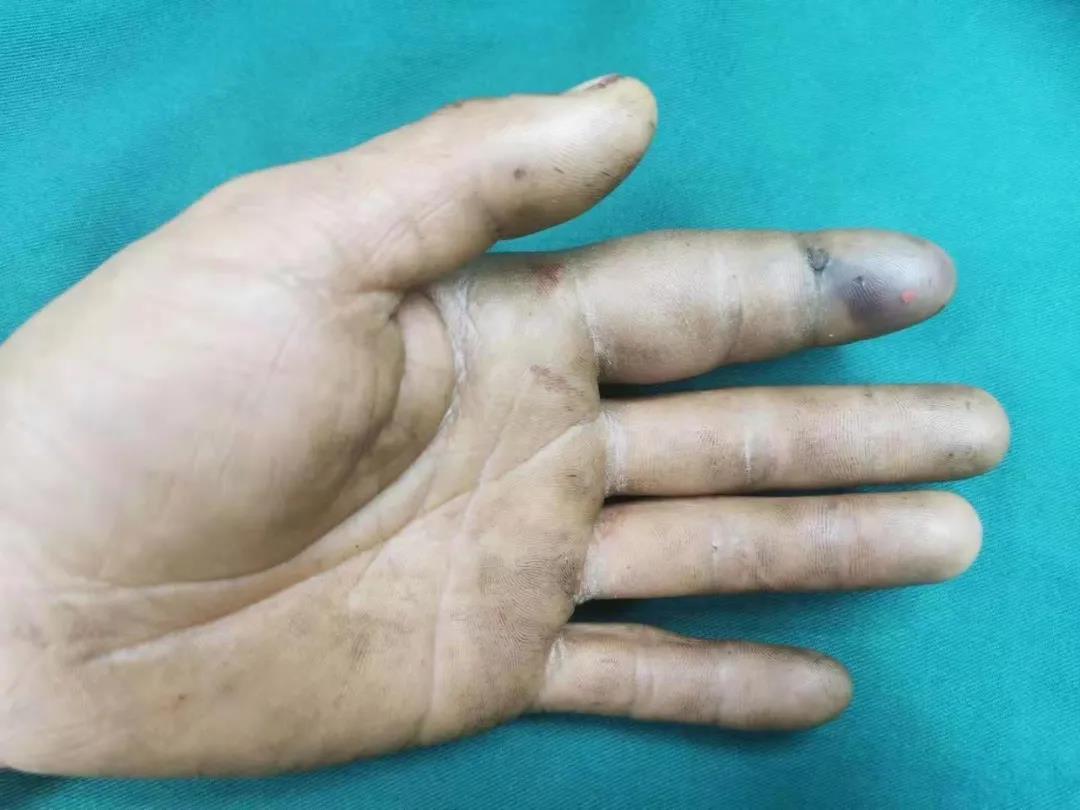 注意！手指被柴油“射”中，一船員差點要被截指！